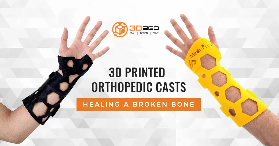 3D Printed Orthopedic Casts
