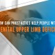 Prosthetics For People With Congenital Upper Limb Deficiency