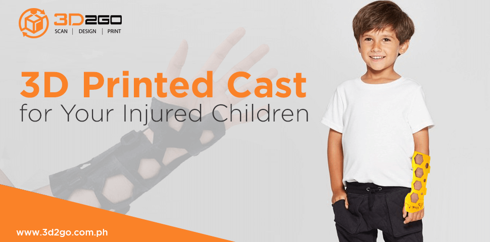 3D Printed Cast for Your Injured Children